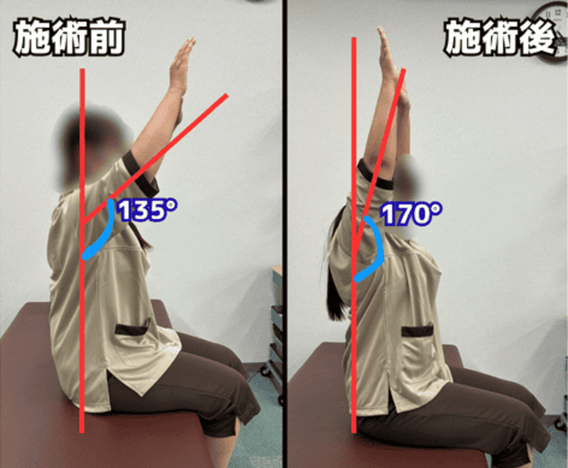 肩関節可動域改善